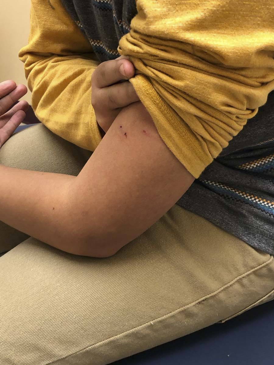 The attack left Kelan Jordan with two puncture wounds in his left arm. One still has a pencil tip embedded under the skin. Photo courtesy Karah Jordan