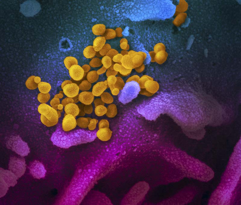 This scanning electron microscope image shows SARS-CoV-2 (yellow)—also known as 2019-nCoV, the virus that causes COVID-19—isolated from a patient in the U.S., emerging from the surface of cells (blue/pink) cultured in the lab. Image courtesy NIAID-RML