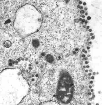 Coronavirus from SARS isolated in FRhK-4 cells. Thin section electron micrograph and negative stained virus particles. Photo courtesy Department of Microbiology, The University of Hong Kong and the Government Virus Unit, Department of Health, Hong Kong SAR China