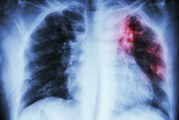 Public Health evaluating active Tuberculosis case at Heritage High School